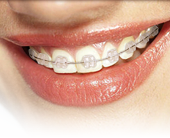 clear ceramic braces