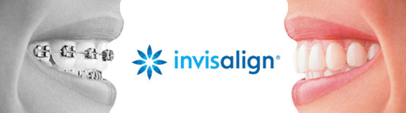 Invisalign Treatment